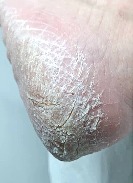 עקבים סדוקים עם הצטברות עור קשה וקאלוס לפני טיפול פדיקור רפואי