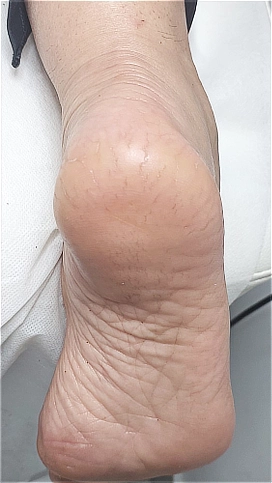 עור עקב חלק וגמיש לאחר טיפול יסודי בסדקים והחזרת הלחות לעור