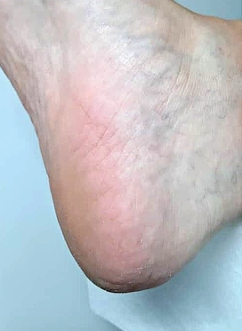 עור עקב חלק, בריא ונטול סדקים לאחר טיפול פדיקור רפואי יסודי