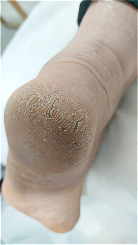 סדקים עמוקים ויובש קיצוני בעקבים לפני טיפול פדיקור רפואי משקם