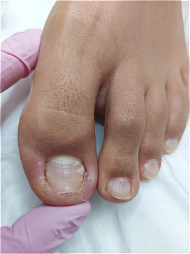 שחרור הלחץ מהעור והקלה מיידית בדלקת לאחר טיפול בציפורן חודרנית