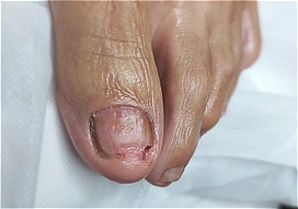 מראה הציפורן לאחר ניקוי עמוק של הפטרת ושחרור הלחץ החודרני להקלה מיידית