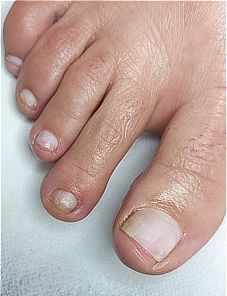 ציפורן נקייה ודקה לאחר השחזה מקצועית וניקוי פטרת הציפורניים