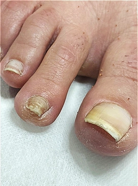 ציפורן מעובה, צהובה ונגועה בפטרת לפני טיפול פדיקור רפואי יסודי